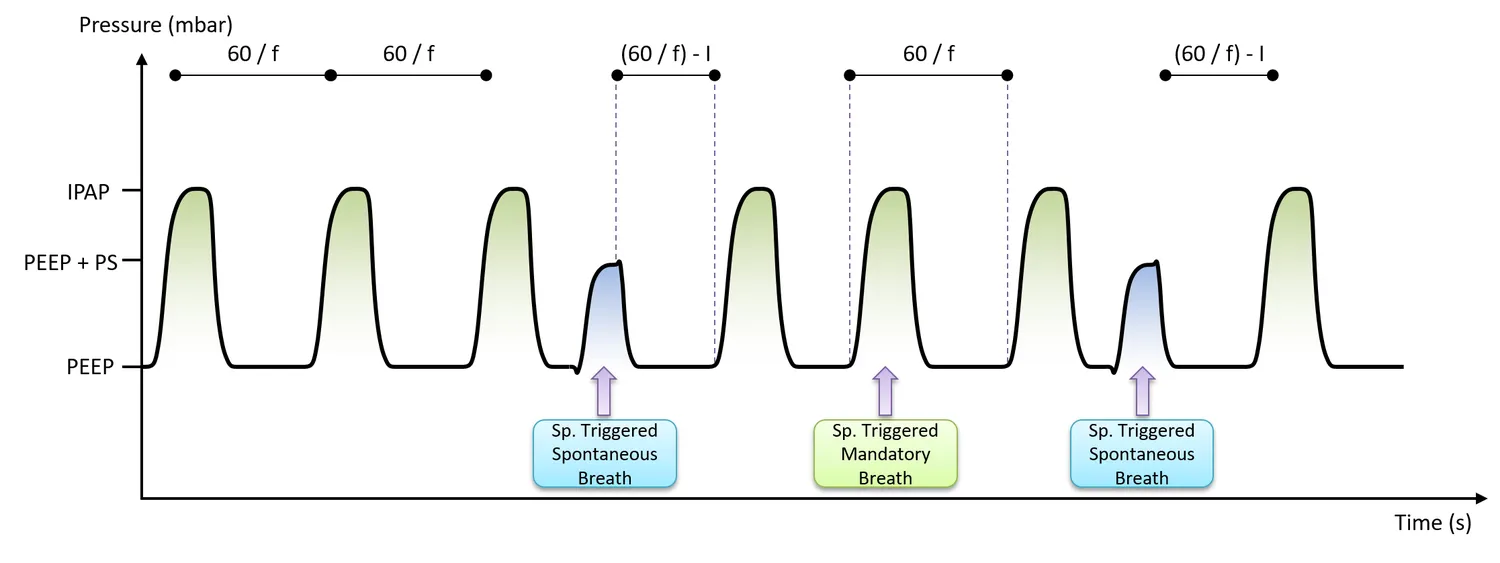 SIMV-P waveform